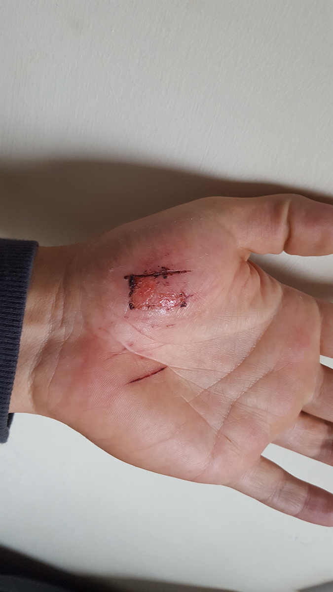Marcin, who suffered a homophobic attack in the Phoenix Park, showing his injured hands