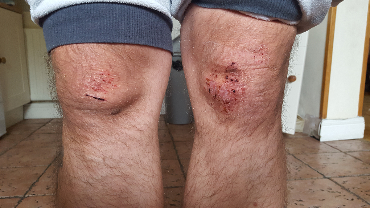 Marcin, who suffered a homophobic attack in the Phoenix Park, showing his injured knees