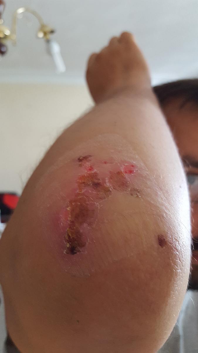 Marcin, who suffered a homophobic attack in the Phoenix Park, showing his injured elbow