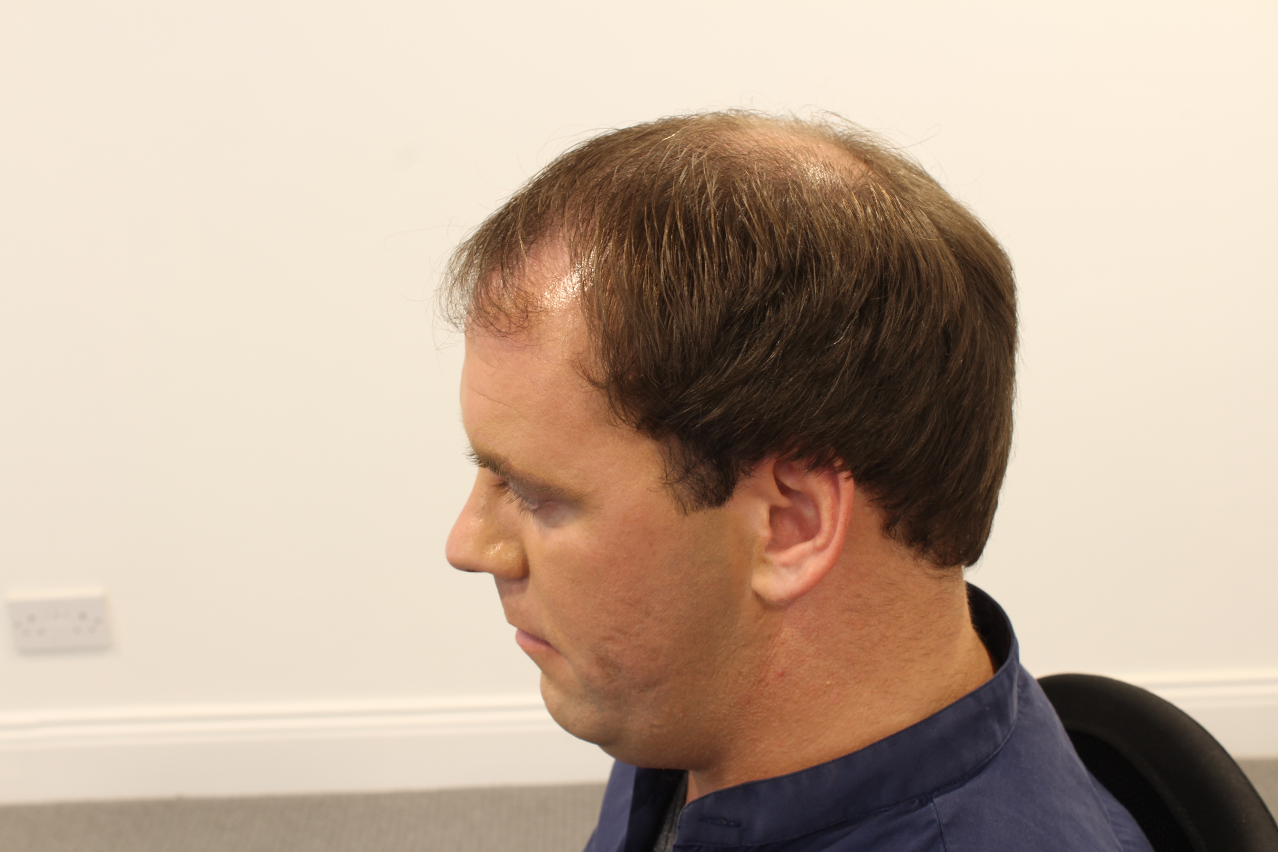 Before of one of Premier Hair Restoration Clinics clients
