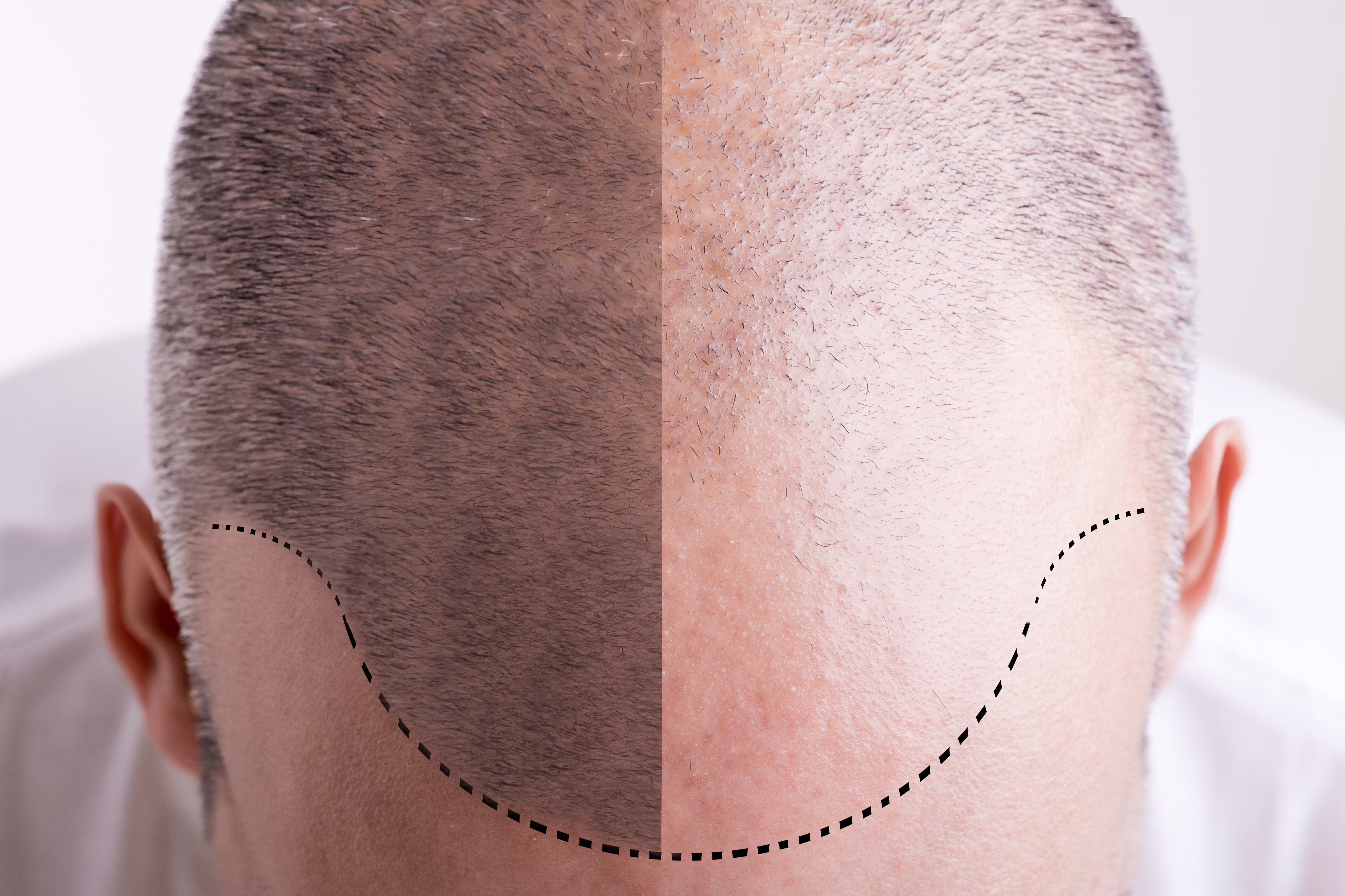 Photo of the top of a Premier Hair Restoration Clinincs head