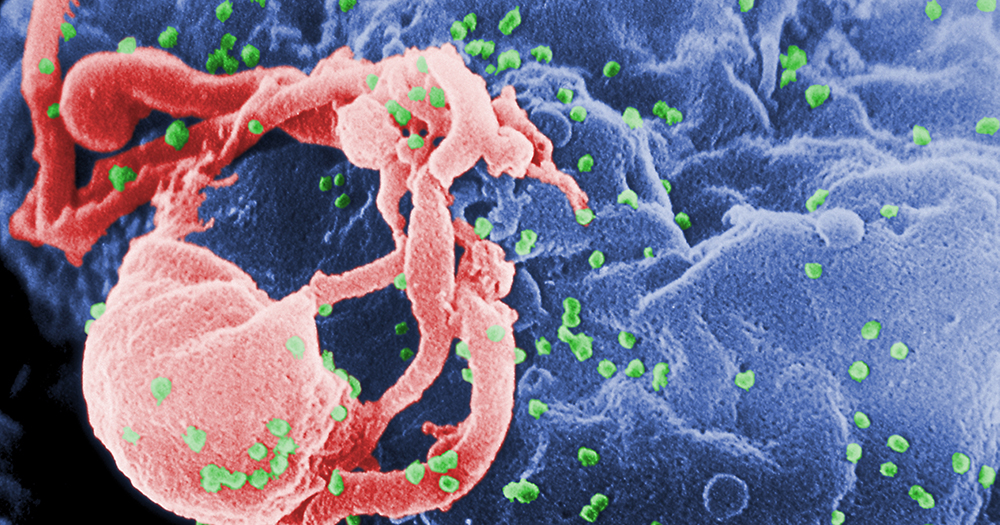 A magnified image of HIV strain infected cell