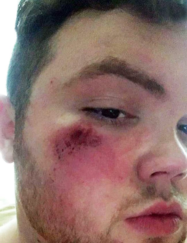Dean Wheeler is pictured with cuts and bruises on his face after homophobic attack
