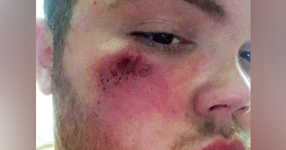 Dean Wheeler is pictured with cuts and bruises on his face after homophobic attack