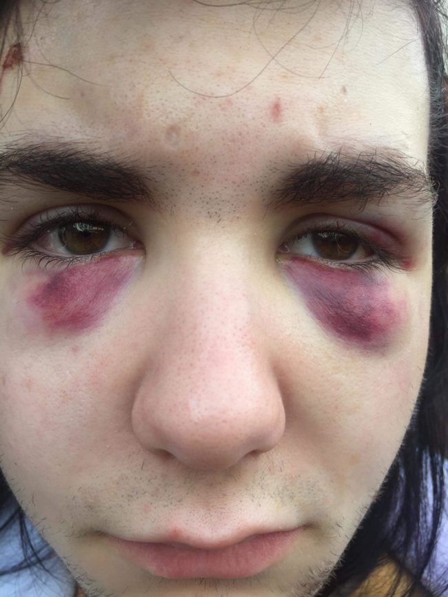 queer teenager who was beaten up in Bristol
