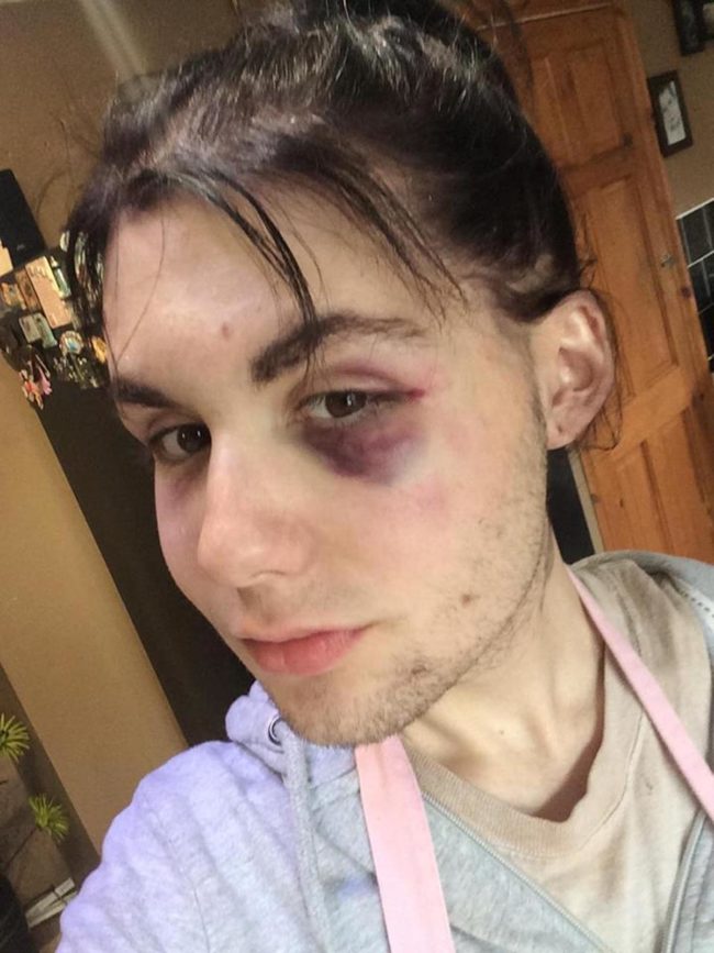 queer teenager who was beaten up in Bristol