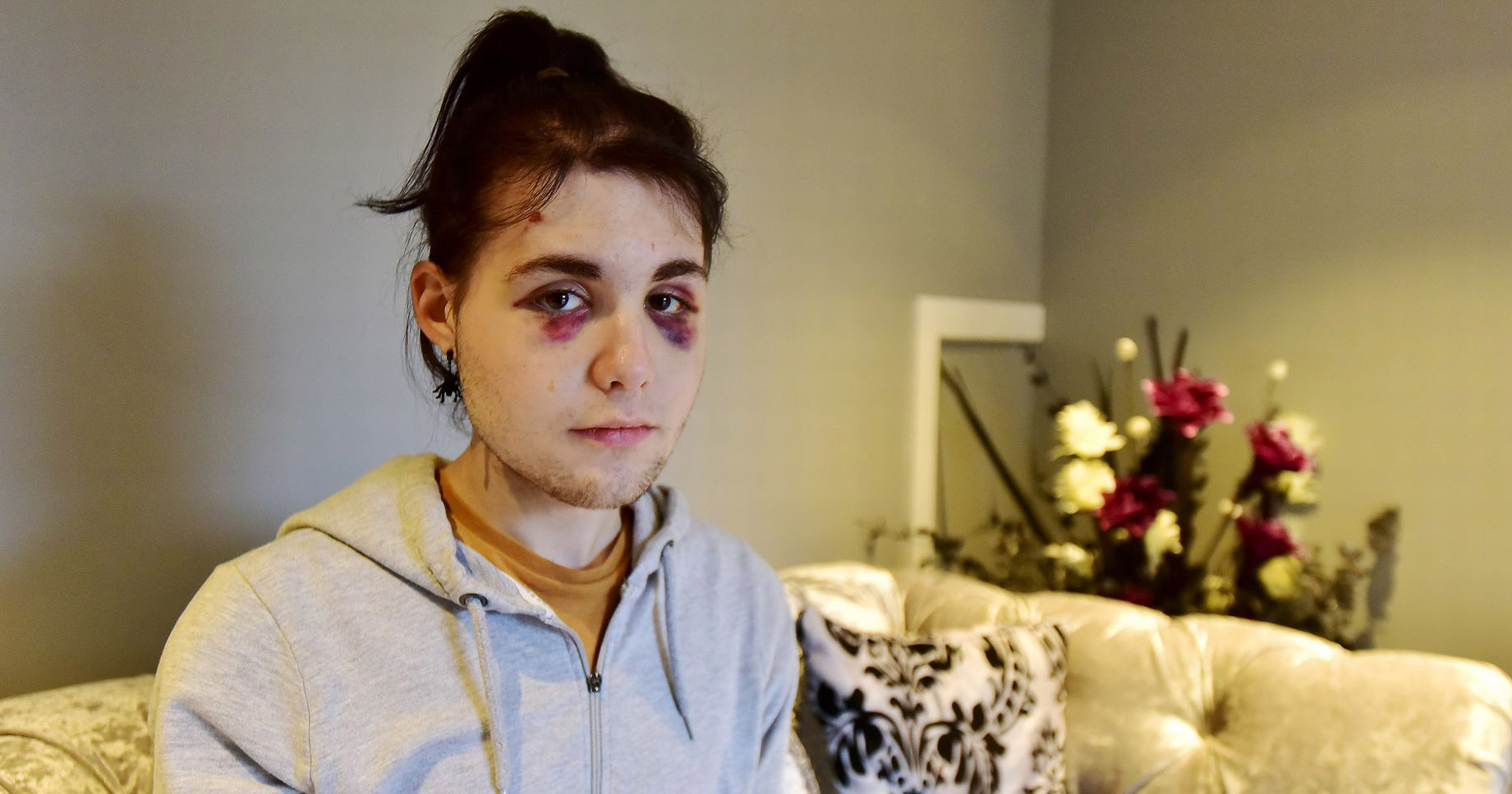 queer teenager who was attacked with his injuries