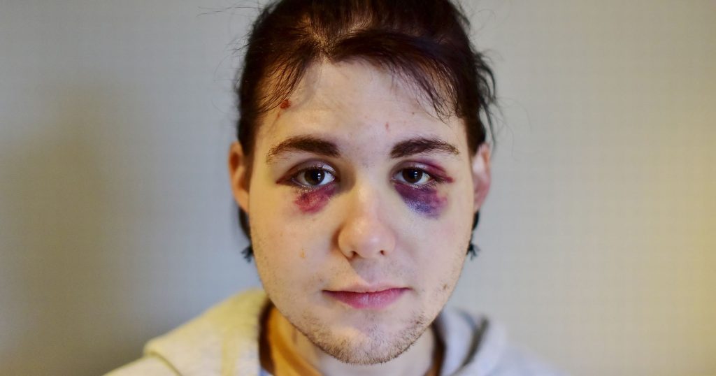 A bruised Kydis Zellinger whose homophobic attacker was jailed