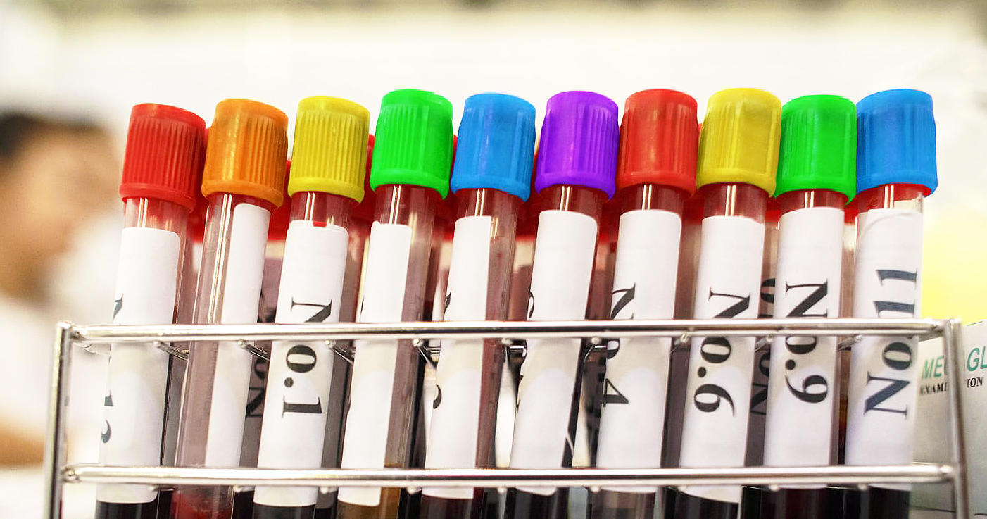 A row of blood filled vials with variously coloured lids