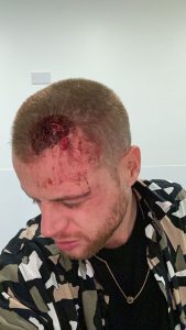 A man looking at the ground with blood on his head