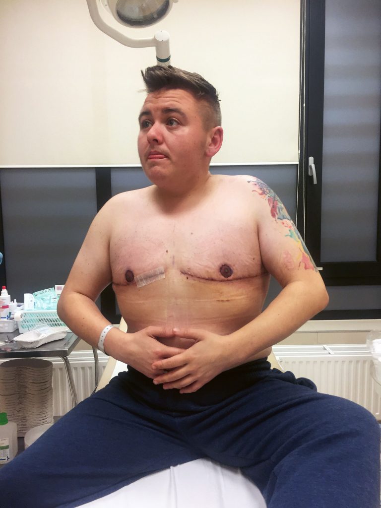 Young trans man sitting on an hospital bed after bandages from his top surgery have been removied