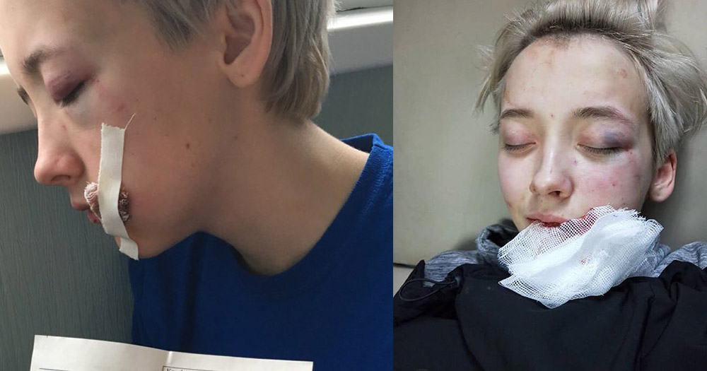 Images of teenage girl's injuries following suspected homophobic attack in Russia. Images show stitches beside her mouth.